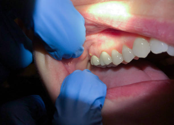 Best Emergency Treatment for Dental Infections or Abscesses in Luverne, MN
